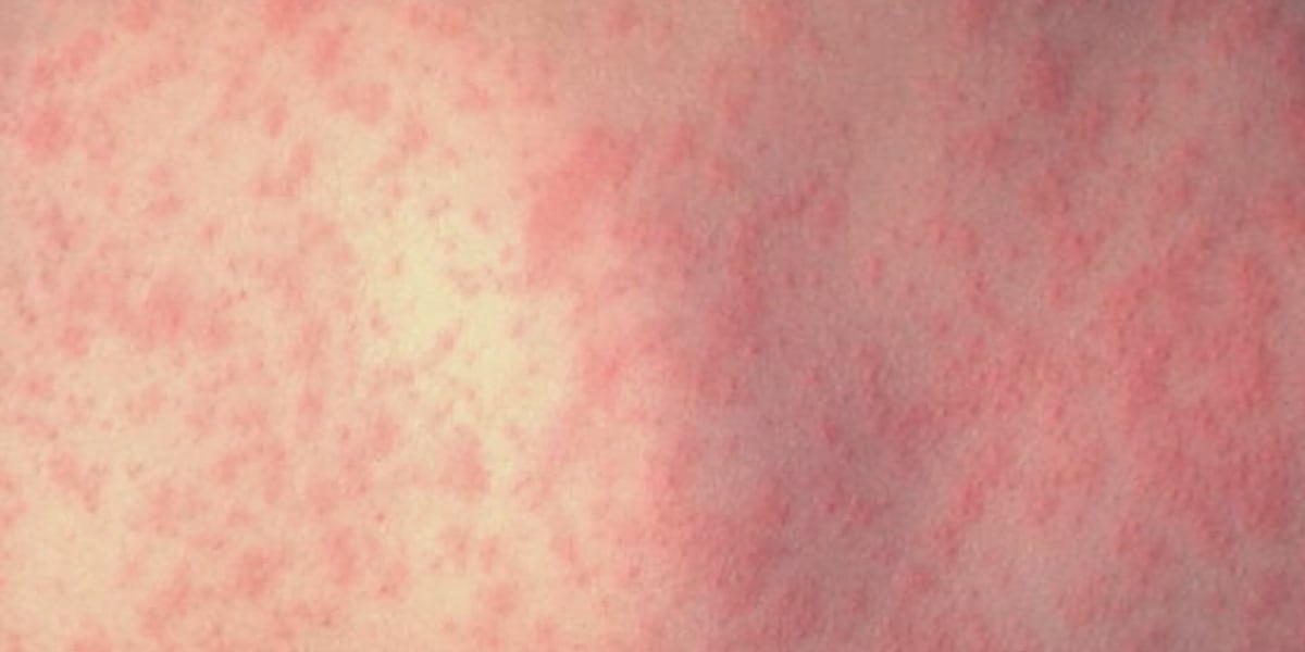 Gregg County Health Department confirms 19-year-old tested from Upshur County positive for measles